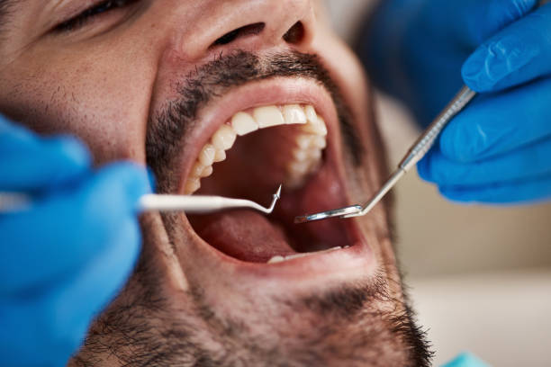 Best Emergency Dentist for Lost Fillings or Crowns in Lancaster, SC
